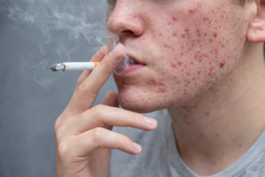 garoto com acne fumando